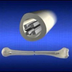 Illustration of bone implant